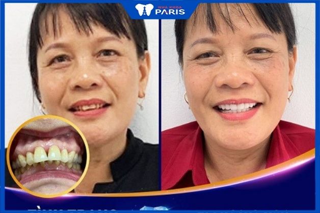 Khách hàng lớn tuổi bọc răng sứ giải quyết tình trạng dáng răng xấu