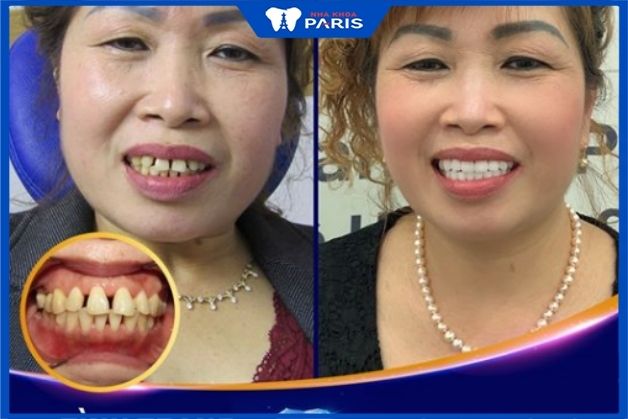 Khách hàng bọc răng sứ an toàn tại nha khoa PARIS