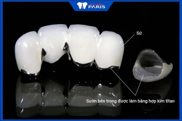 Cấu tạo răng sứ Titan vita