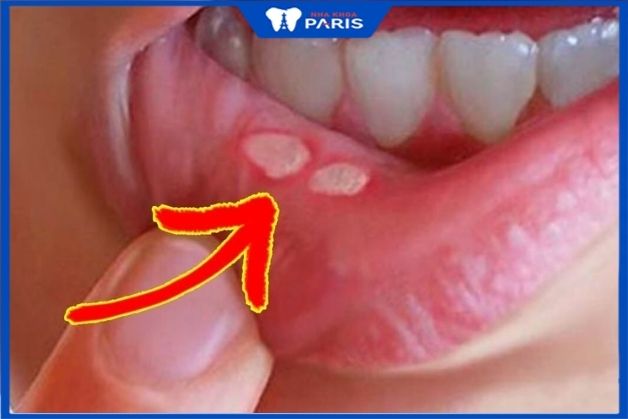 Chữa trị các bệnh răng miệng trước khi bọc răng giả
