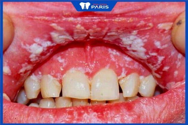 Một trường hợp tổn thương hàm miệng nghiêm trọng do điều trị tại nha khoa kém uy tín cách giảm ê buốt răng sau khi tẩy trắng