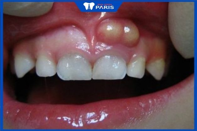 Hình ảnh đáng sợ của bệnh áp xe răng