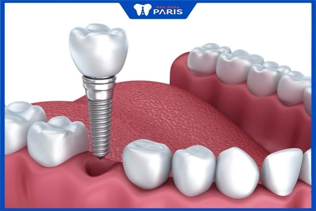 Cấy ghép Implant là một kỹ thuật tiên tiến nhằm phục hình chiếc răng đã mất cấy ghép implant tại Hà Nội