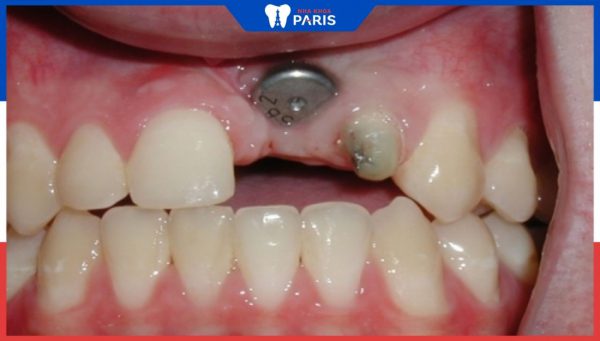 Cấy trụ implant – Công nghệ phục hồi răng mất giống 100% răng thật
