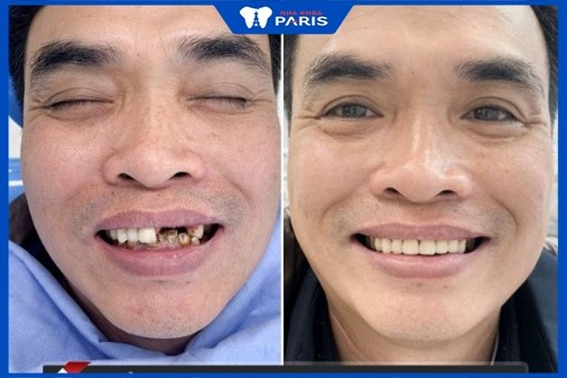 Khách hàng mất nhiều răng nghiêm trọng phục hồi implant tại nha khoa Paris cấy ghép implant