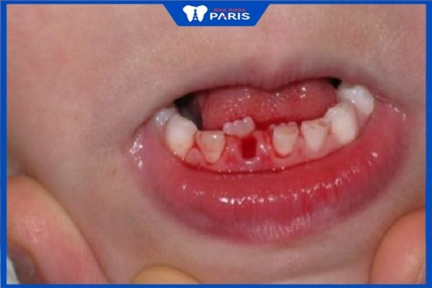 Trẻ dễ bị chảy máu nhiều nếu cha mẹ tự ý nhổ răng