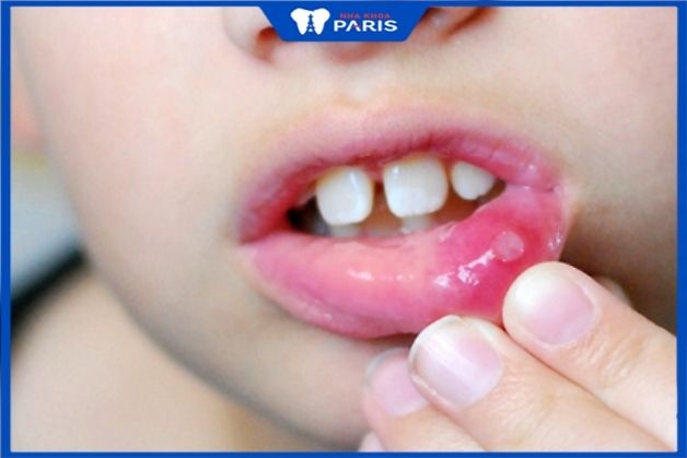Trẻ bị viêm nhiễm hàm miệng bởi cha mẹ nhổ răng không sạch sẽ chi phí nhổ răng sữa