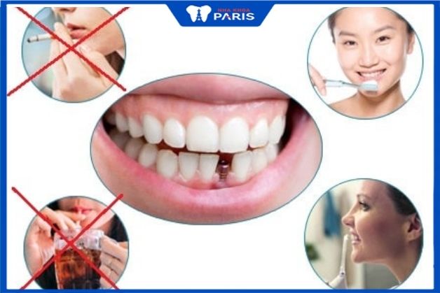 Chăm sóc hàm miệng đúng cách để bảo vệ trụ răng implant gãy vít abutment