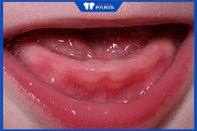 Nướu sưng đỏ là dấu hiệu răng sữa bắt đầu nhú lên