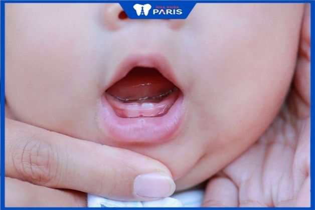 Răng cửa dưới là răng sữa đầu đời của trẻ