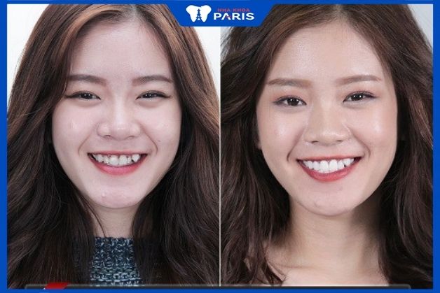 Trước và sau khi bọc răng sứ (khách hàng nha khoa Paris) Làm răng sứ zirconia