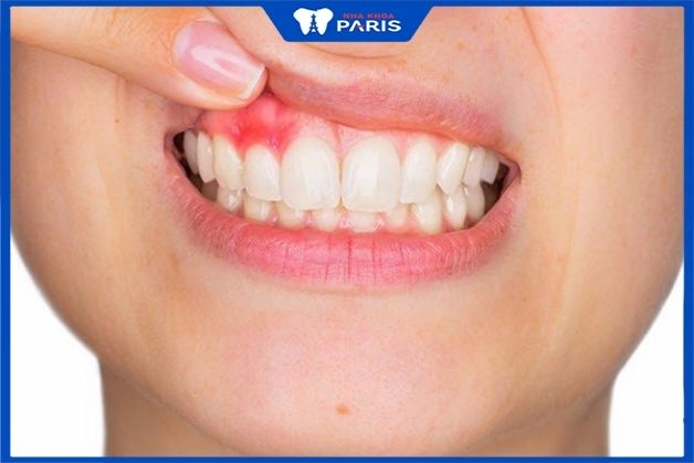 Răng sứ kém chất lượng có thể gây nên tình trạng viêm nướu