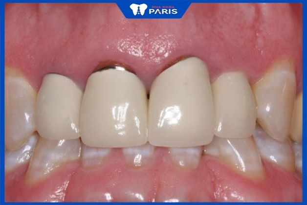 Răng sứ kim loại có thể bị đen viền nướu sau một thời gian sử dụng