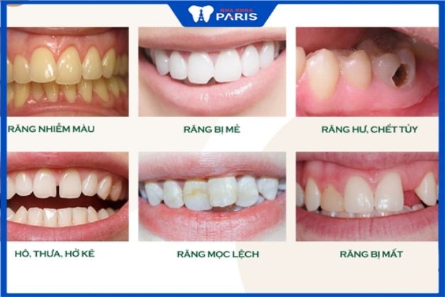 Những khuyết điểm răng nên bọc răng sứ