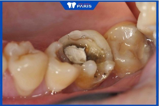 Nhổ răng số 7 hàm dưới khi bị sâu quá nặng