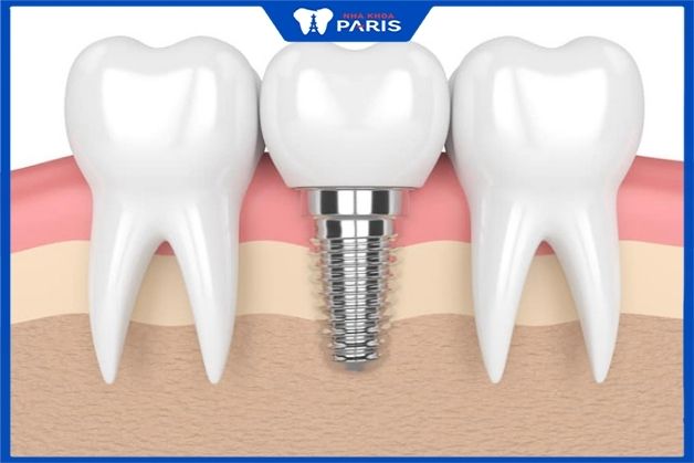 Trồng răng Implant - giải pháp phục hình răng số 7 tối ưu