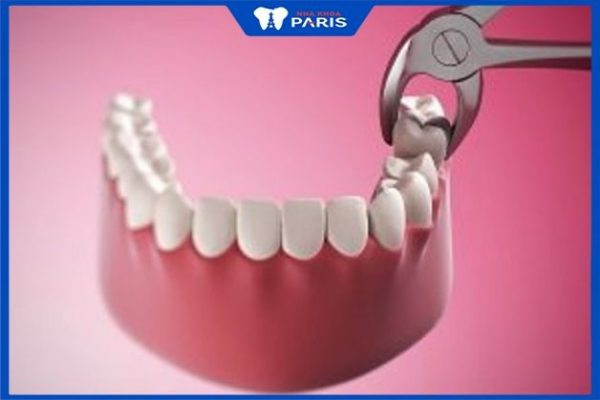 Nhổ răng số 7 hàm dưới có đau không? Bao lâu thì trồng được răng mới?