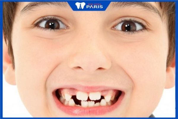 Những lý do khiến răng trẻ dễ bị xô lệch
