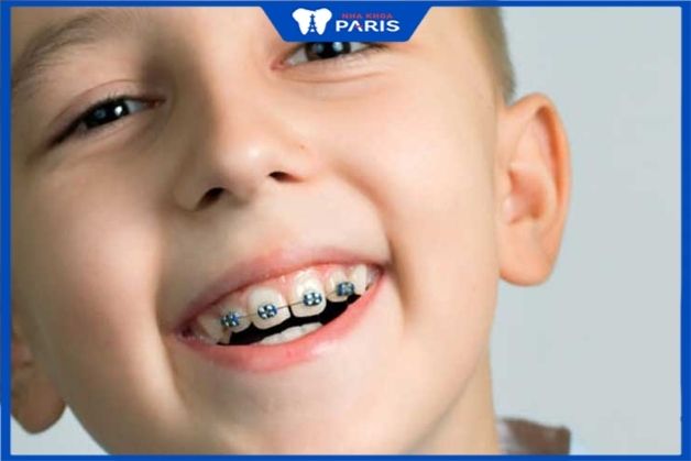 Trẻ em có răng sai lệch nhẹ phù hợp niềng 1 hàm 