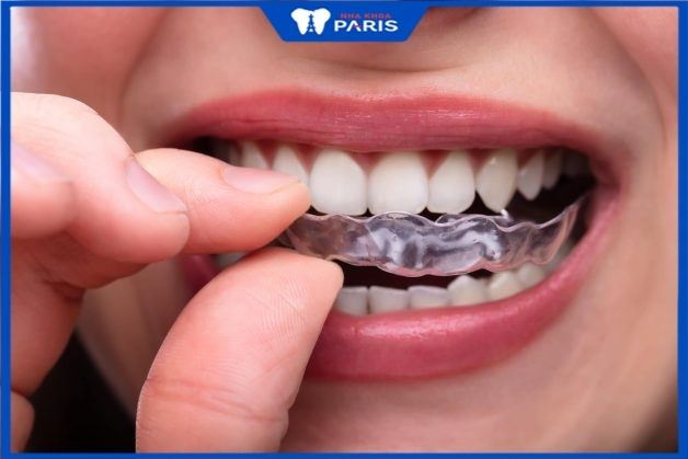Invisalign Express gồm 7 máng niềng trong suốt