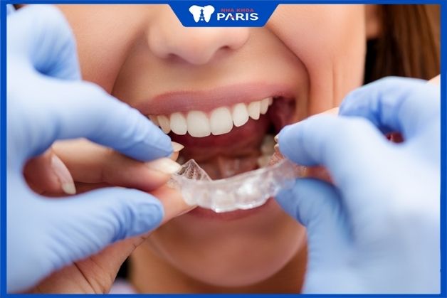 Niềng răng Invisalign là gì? Cơ chế hoạt động ra sao?