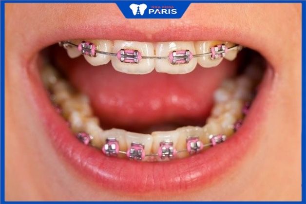 Niềng răng kim loại dạng truyền thống có thun nha khoa