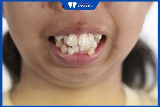 Răng mọc lệch kéo theo mất cân bằng cấu trúc mặt