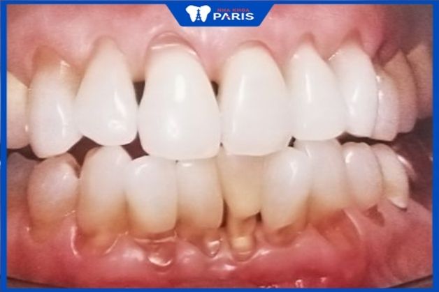Không chăm sóc kỹ nhìn răng lỏng lẻo, tụt lợi, thời gian sử dụng ngắn Răng sứ cercon sử dụng được bao lâu