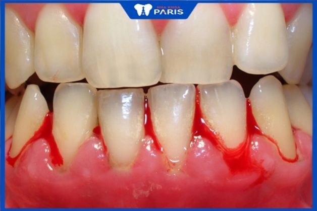 Điều trị khỏi bệnh nha chu mới đủ điều kiện niềng răng