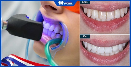 Tẩy trắng răng bằng công nghệ Plasma Whitemax