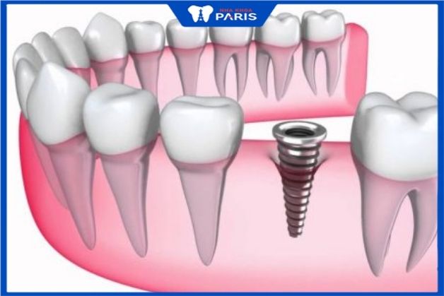 Cắm trụ implant vào ổ răng thay thế xương răng mất