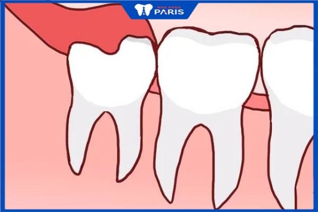 Răng khôn mọc thẳng giống các răng khác