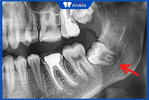 Hình ảnh x-quang của người có răng khôn chèn dây thần kinh