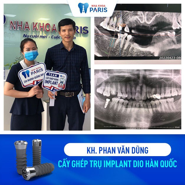 Khách hàng Phan Văn Dũng trồng răng Implant