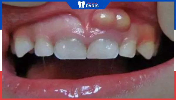 Cách điều trị viêm nướu răng có mủ an toàn, đơn giản