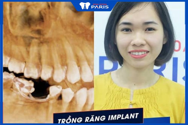 Cắm trụ răng Implant có đau không? Chị Nguyễn Thu Hương chia sẻ