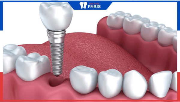 Cắm trụ răng Implant có đau không?