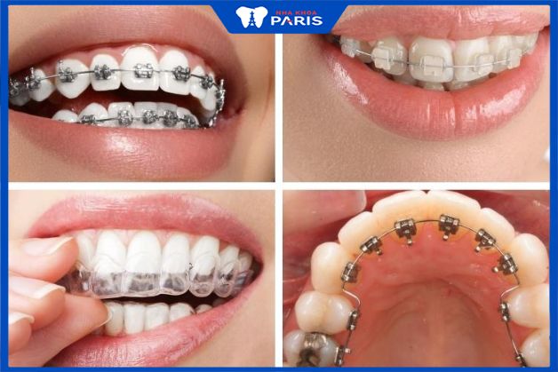 Các yếu tố ảnh hưởng đến thời gian niềng răng khấp khểnh