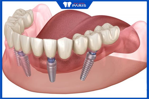 Chi tiết thời gian lành thương răng Implant