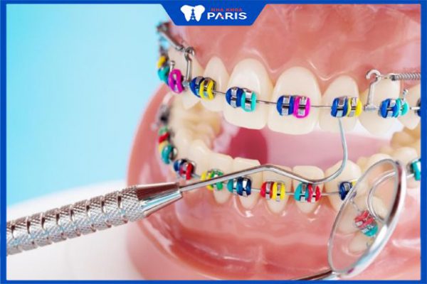 Đặc điểm và cách thức hoạt động của niềng răng mắc cài thường