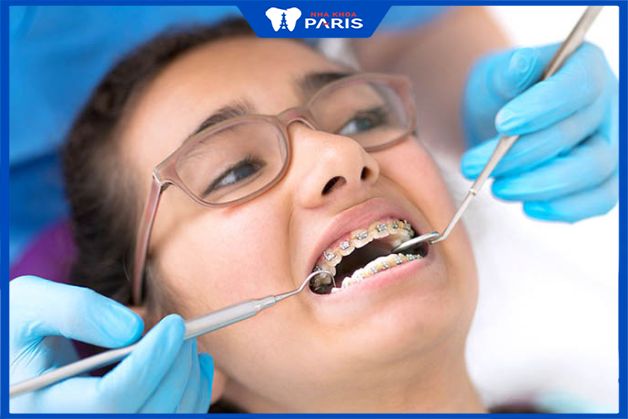 Làm sao để giảm thời gian chỉnh răng khấp khểnh?