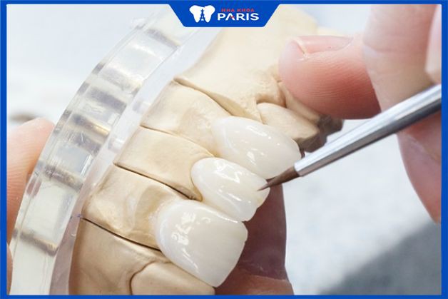 Lắp thử răng sứ và kiểm tra độ chuẩn xác
