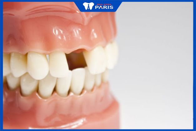 Mất răng nhiều năm có thể trồng Implant không?