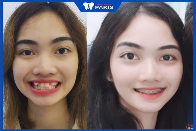Hình ảnh sau niềng răng sau 2 năm của chị Nguyễn Phương Thúy tại nha khoa Paris