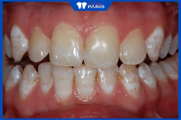 Răng trẻ bị nhiễm fluor nuốt kem đánh răng có sao không