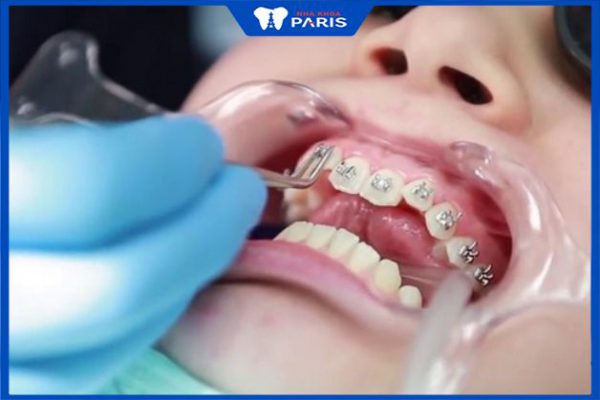 Quy trình y khoa chuẩn niềng răng mắc cài thường