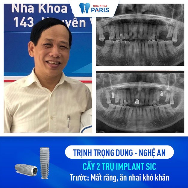 Chú Trịnh Trọng Dung mất 1 răng 6 và 1 răng 7