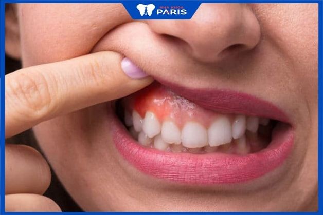 Bệnh lý viêm chân răng là gì?