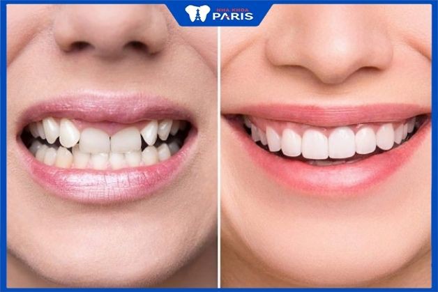 Bọc răng sứ giúp khắc phục tình trạng móm, khấp khểnh