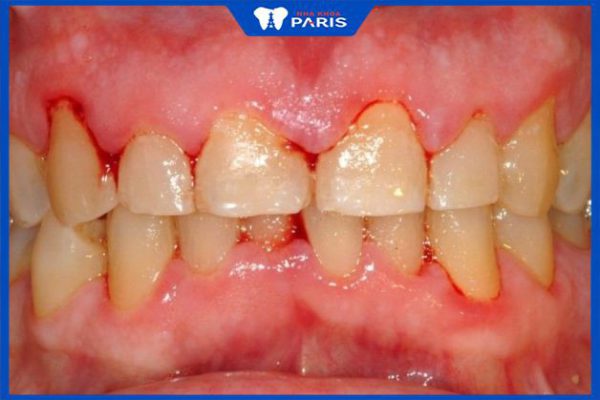 Tổng hợp 8 bệnh lý răng miệng nguy hiểm thường gặp